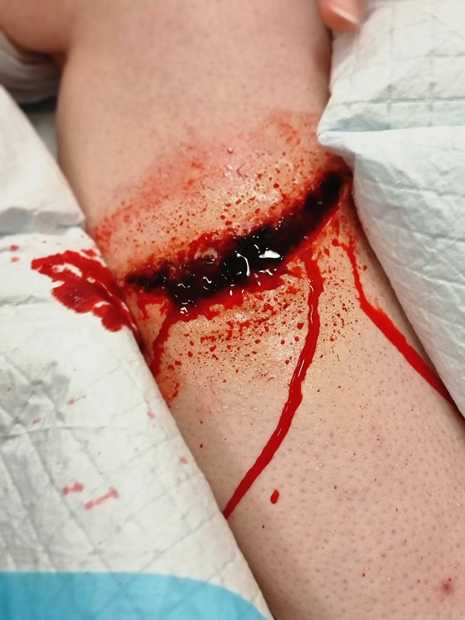Forearm laceration