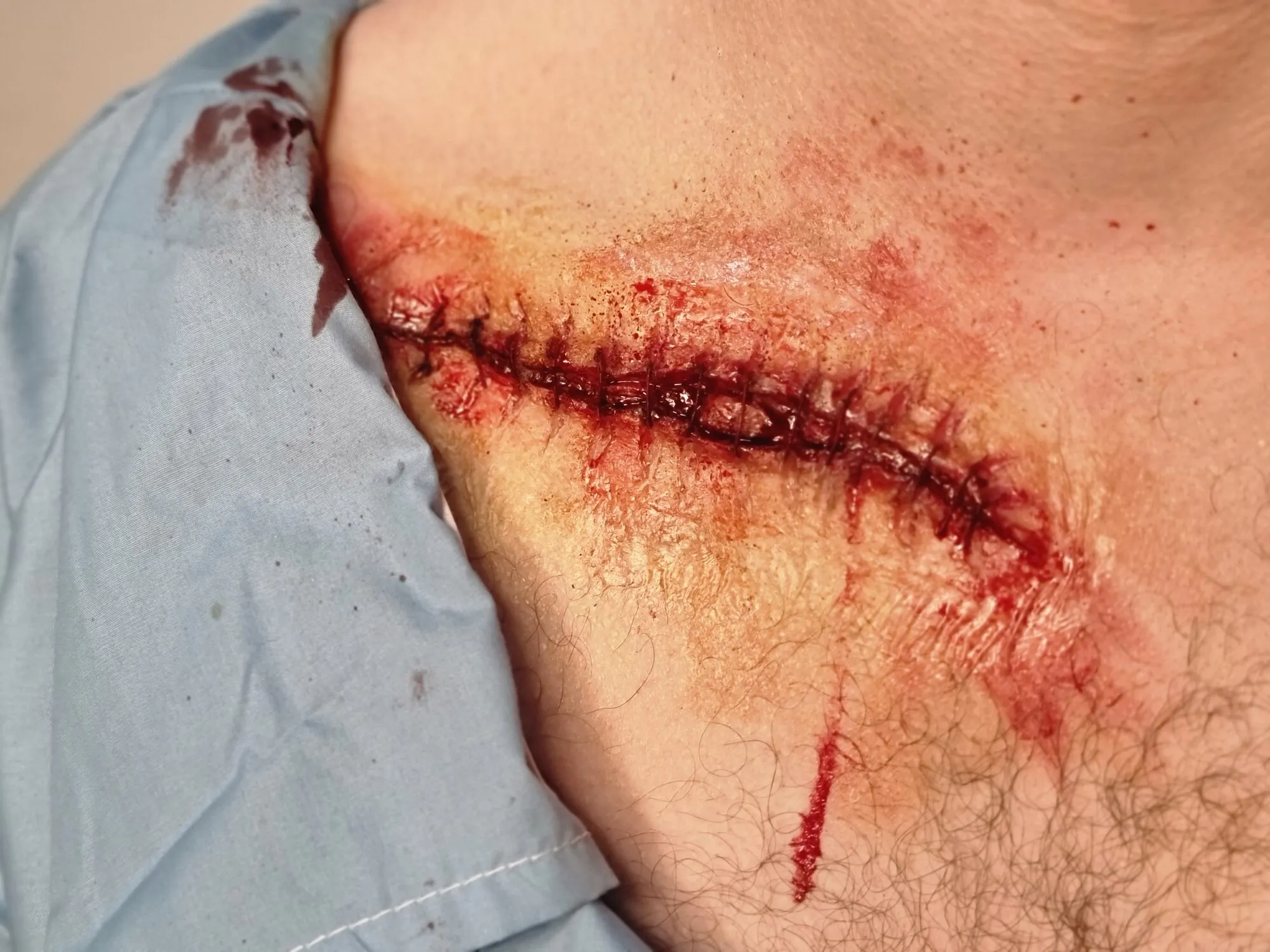 Sutured chest wound