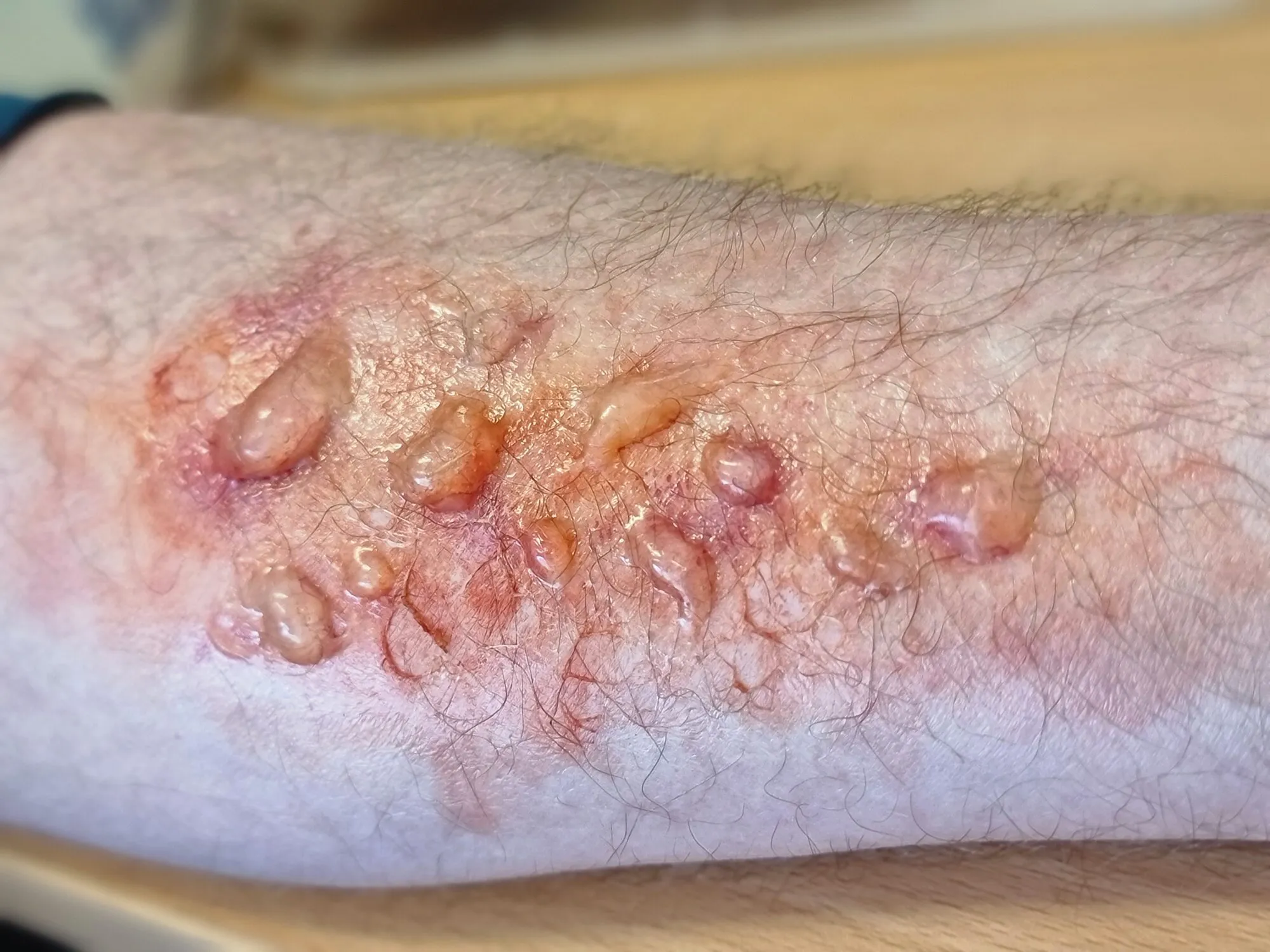 Blistering skin