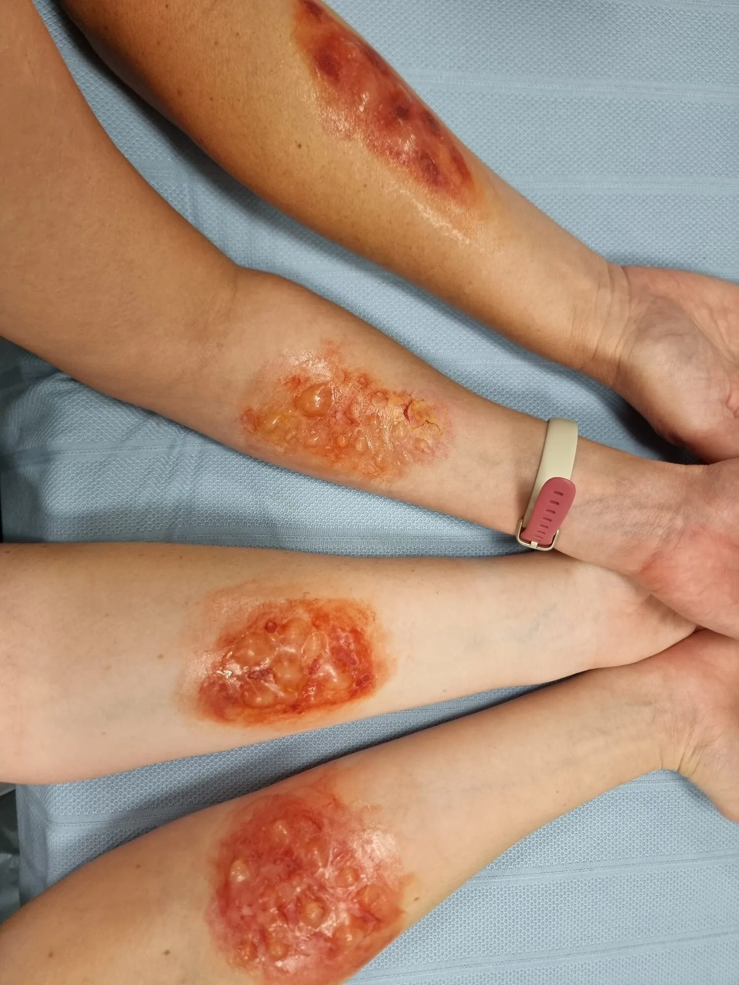 Burn wounds on forearms