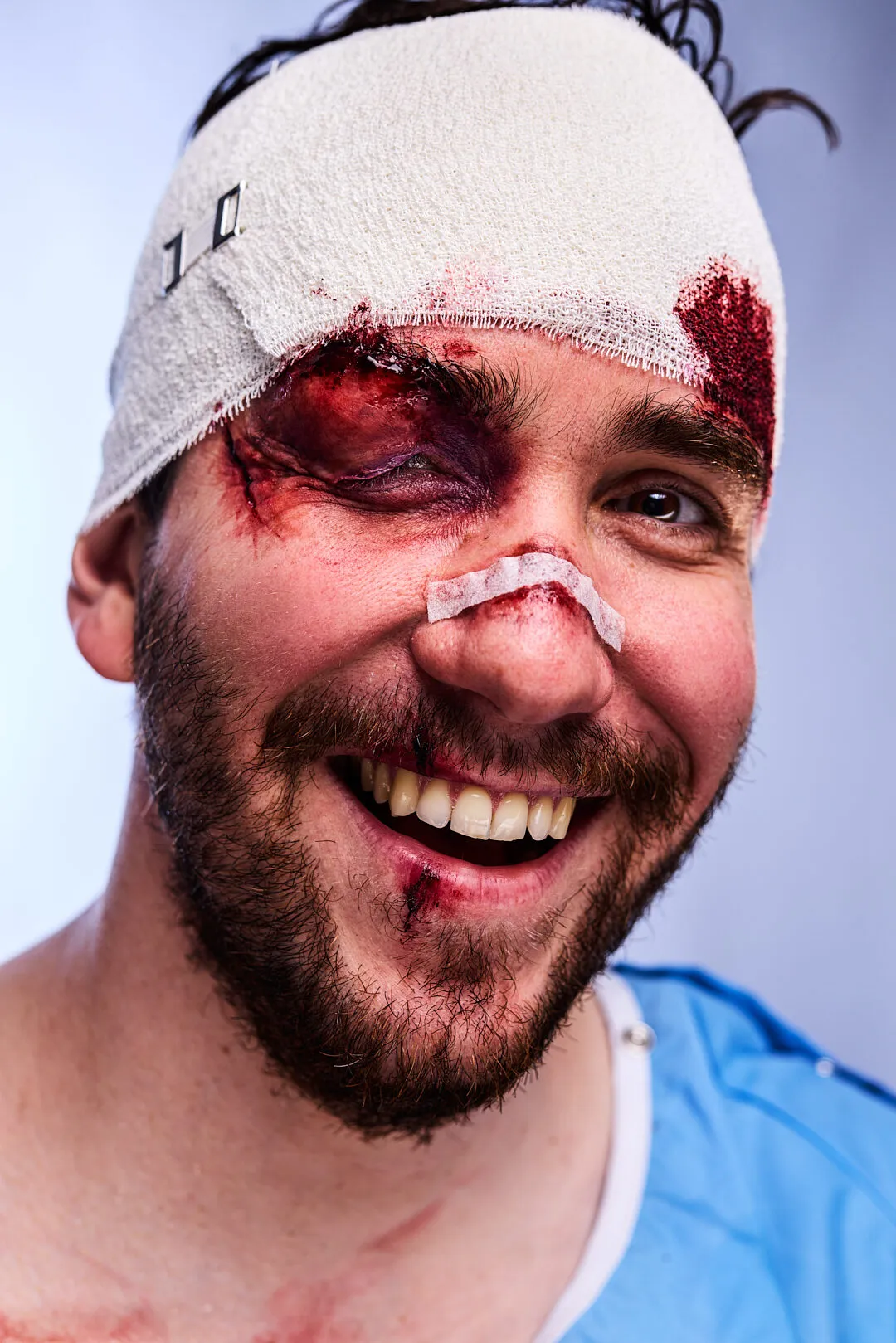 Head injury and black eye