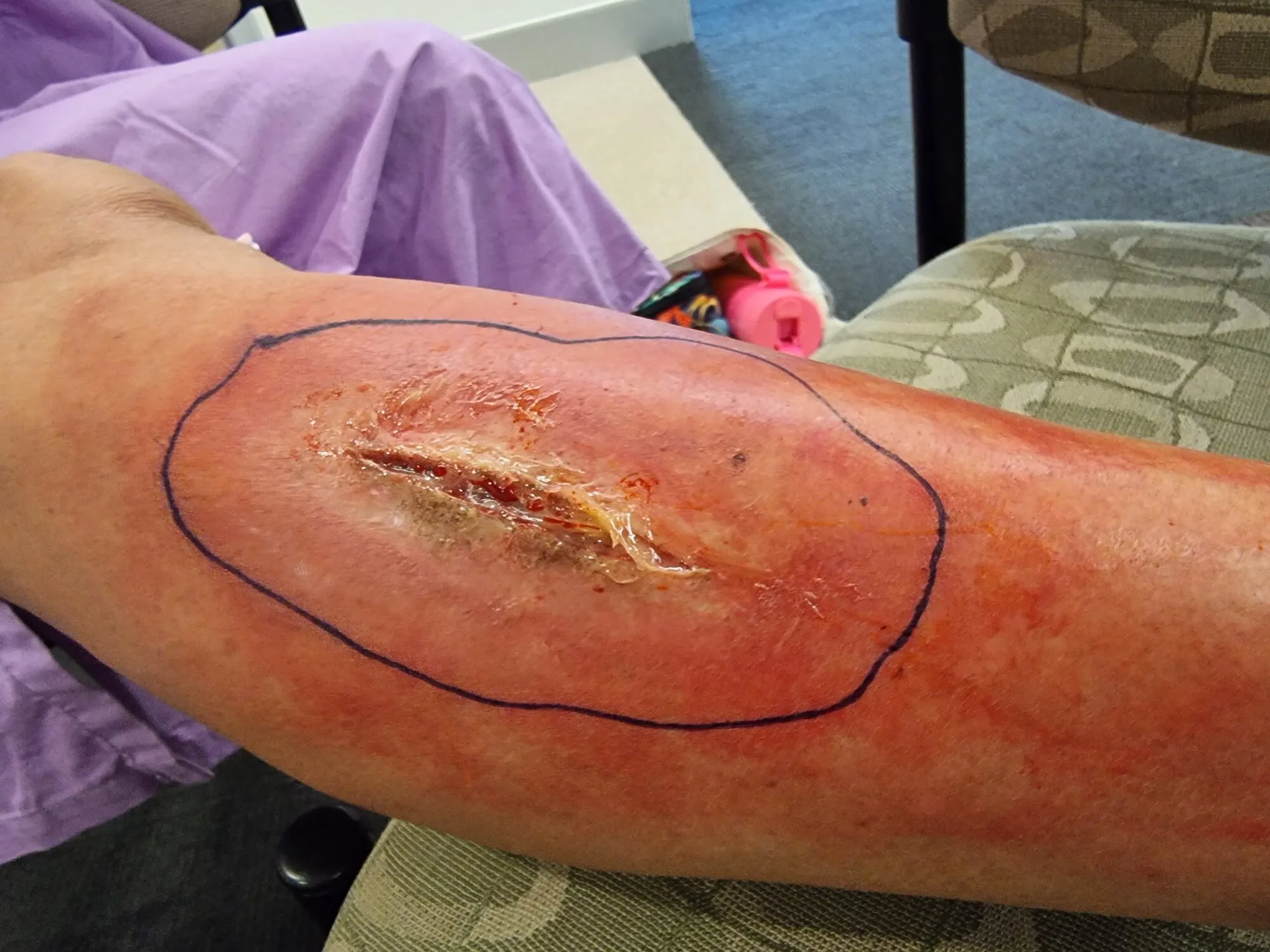 Infected wound