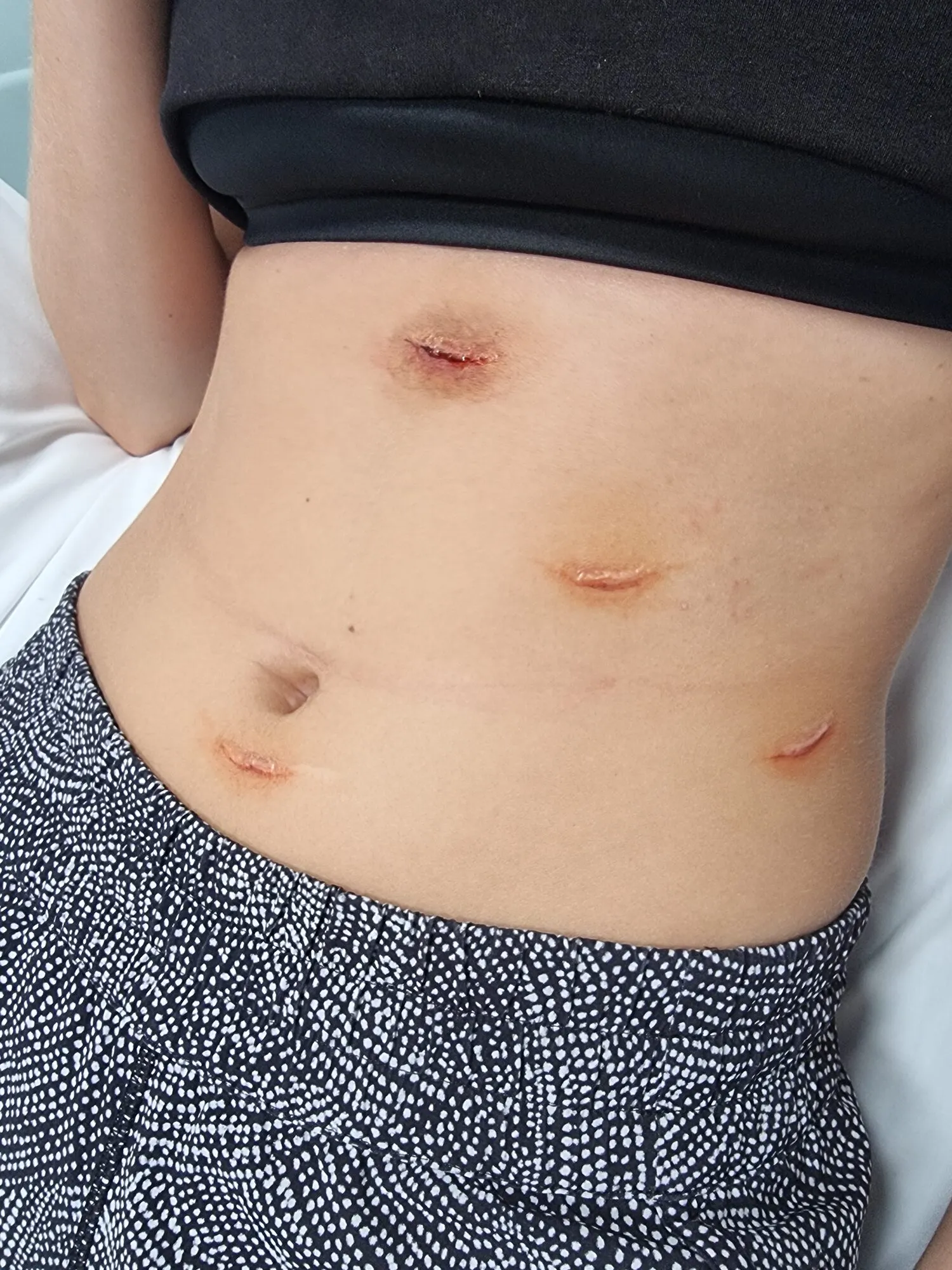 Abdominal scarring