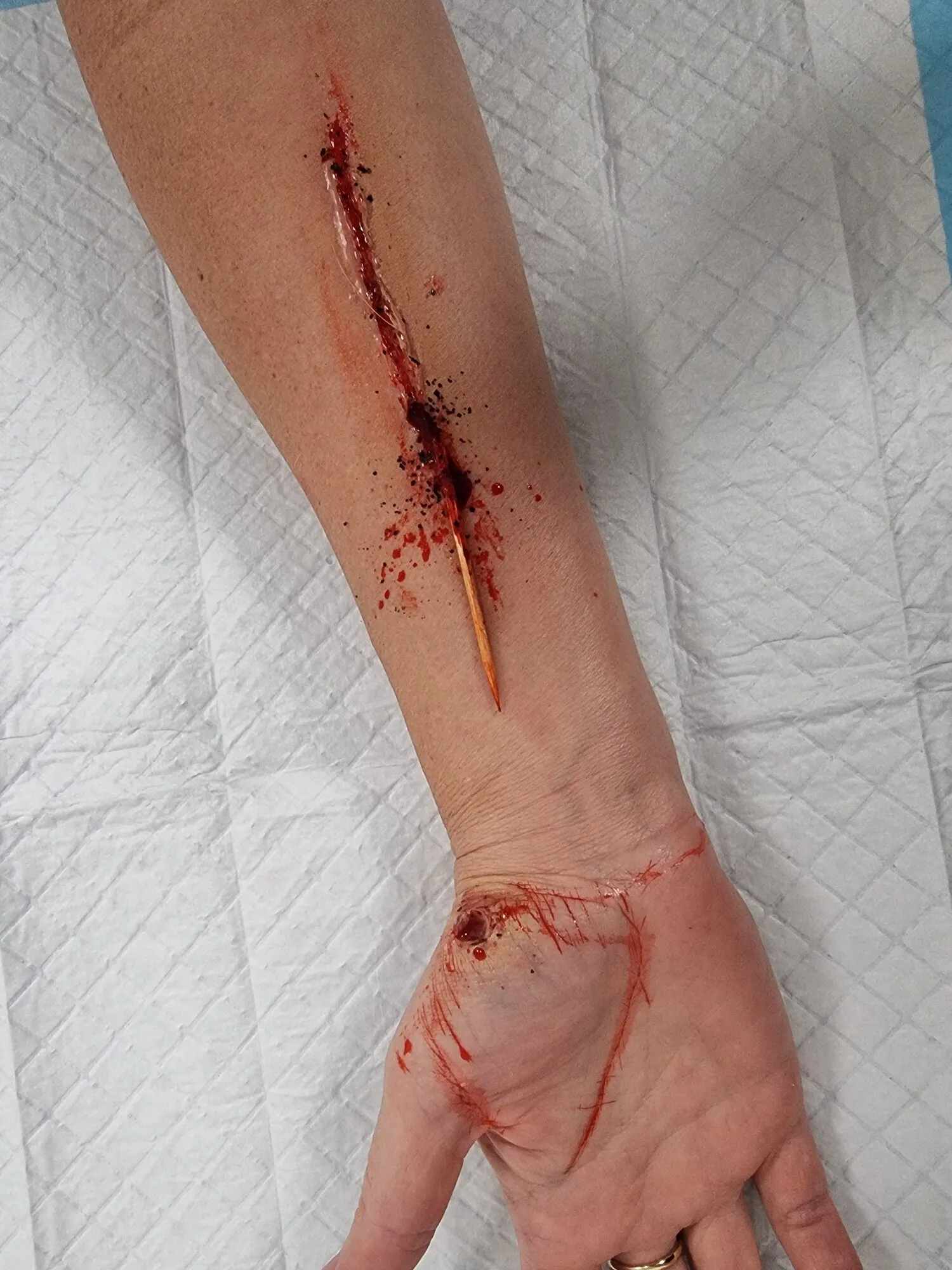 Wrist laceration