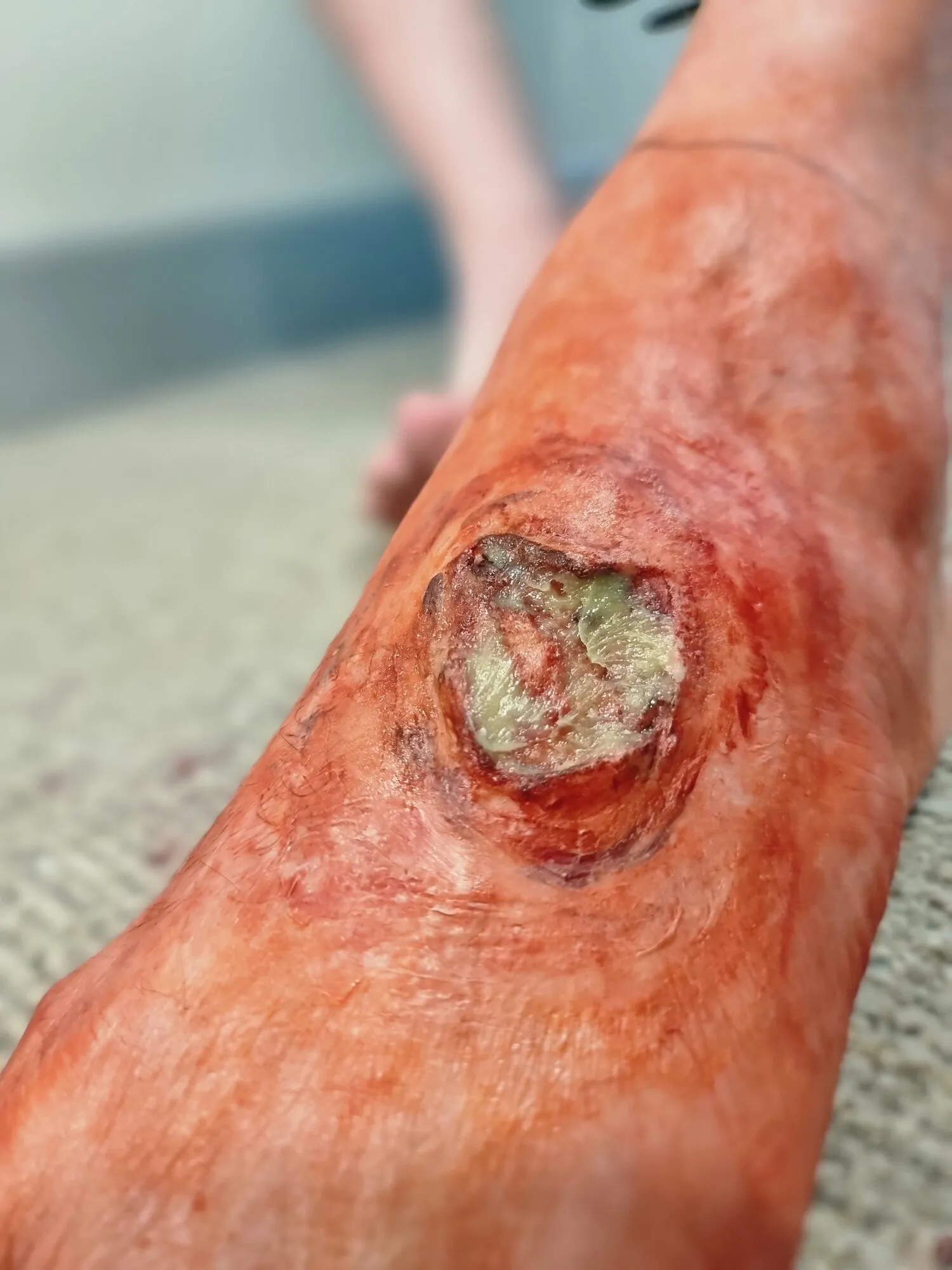 Leg ulcer