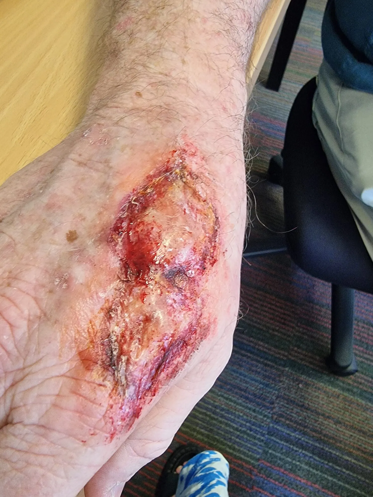 Hand abrasion