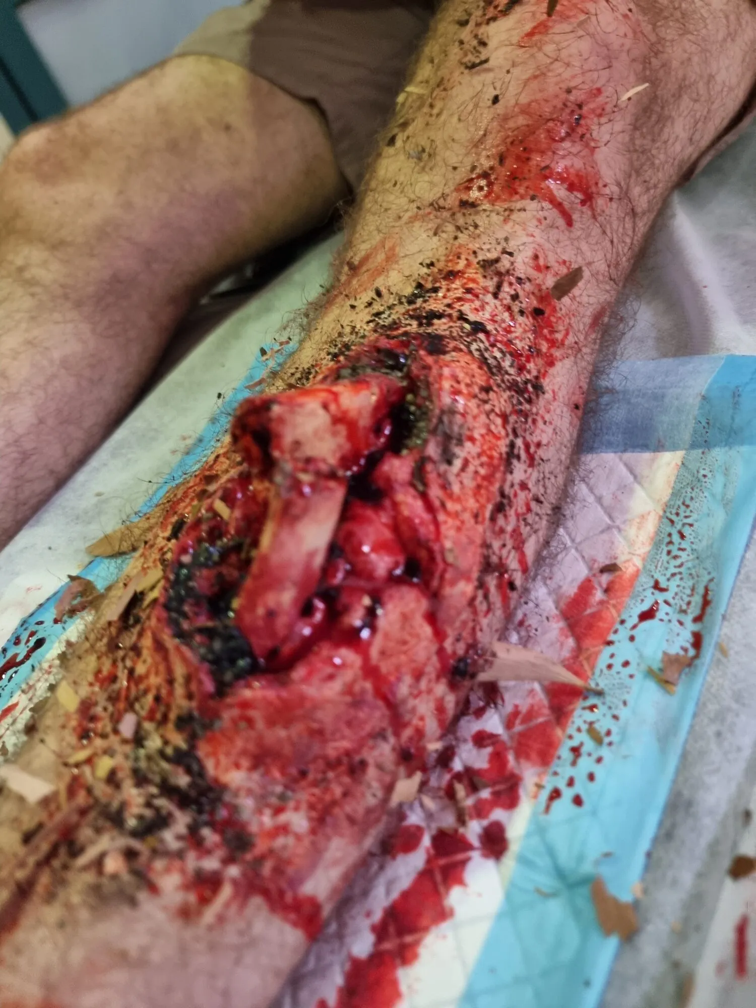 Open leg trauma