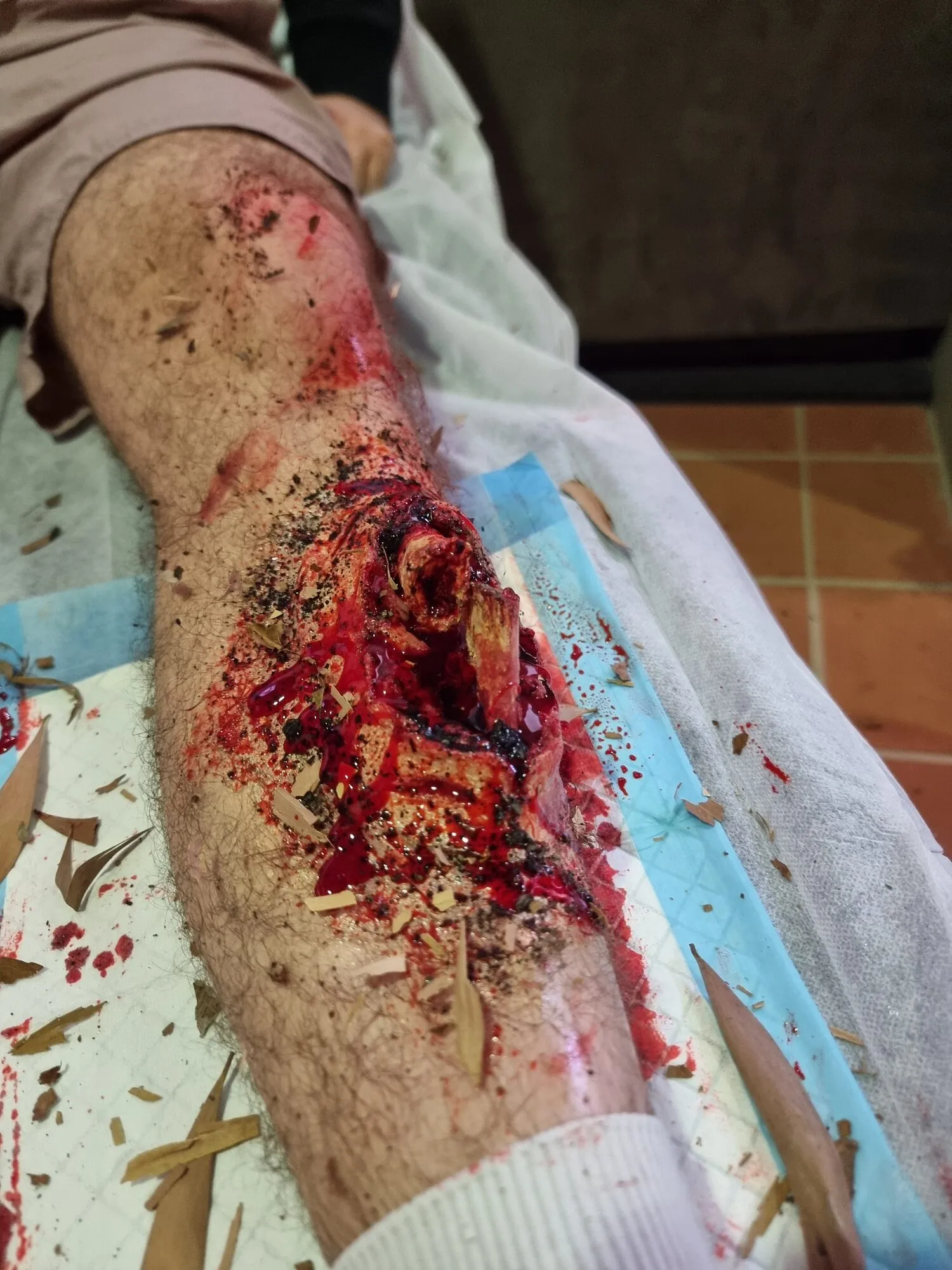 Lower leg trauma